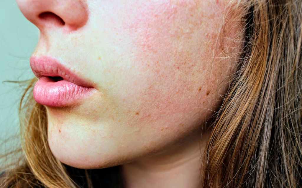 How To Clear My Skin of&nbsp;Acne?